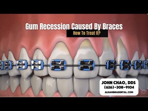 Gum Recession Is a Common Side Effect of Braces?  How To Treat It? 🦷✨#gumrecession #braces