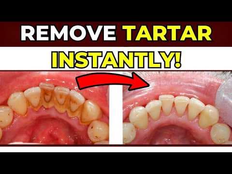 Homemade Recipe for Whiter Teeth and Tartar Prevention (INFALLIBLE)