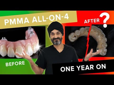 Full Mouth Dental Implants- With PMMA Teeth - One Year On!