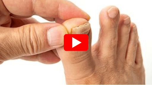 Most people with ugly toenails ignore this early warning sign